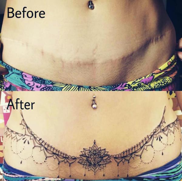 Tummy Tuck Tattoo: What You Need to Know