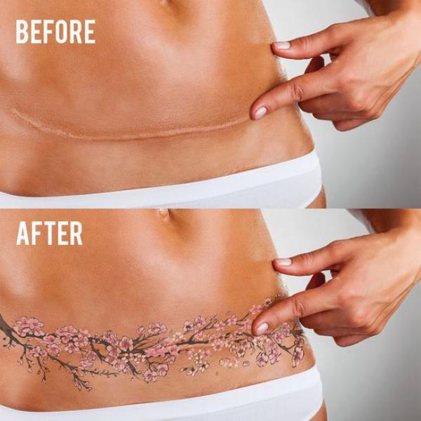 Tummy Tuck Tattoo: What You Need to Know