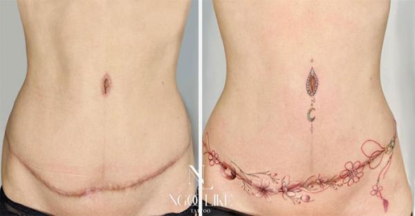 Tummy Tuck Tattoo: What You Need to Know